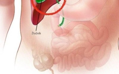 Co se děje s tělem po odstranění žlučníku? 3 nemoci, které mohou následovat – pokud je to možné, vyhněte se operaci