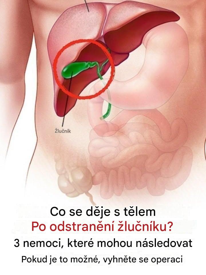 Co se děje s tělem po odstranění žlučníku? 3 nemoci, které mohou následovat – pokud je to možné, vyhněte se operaci