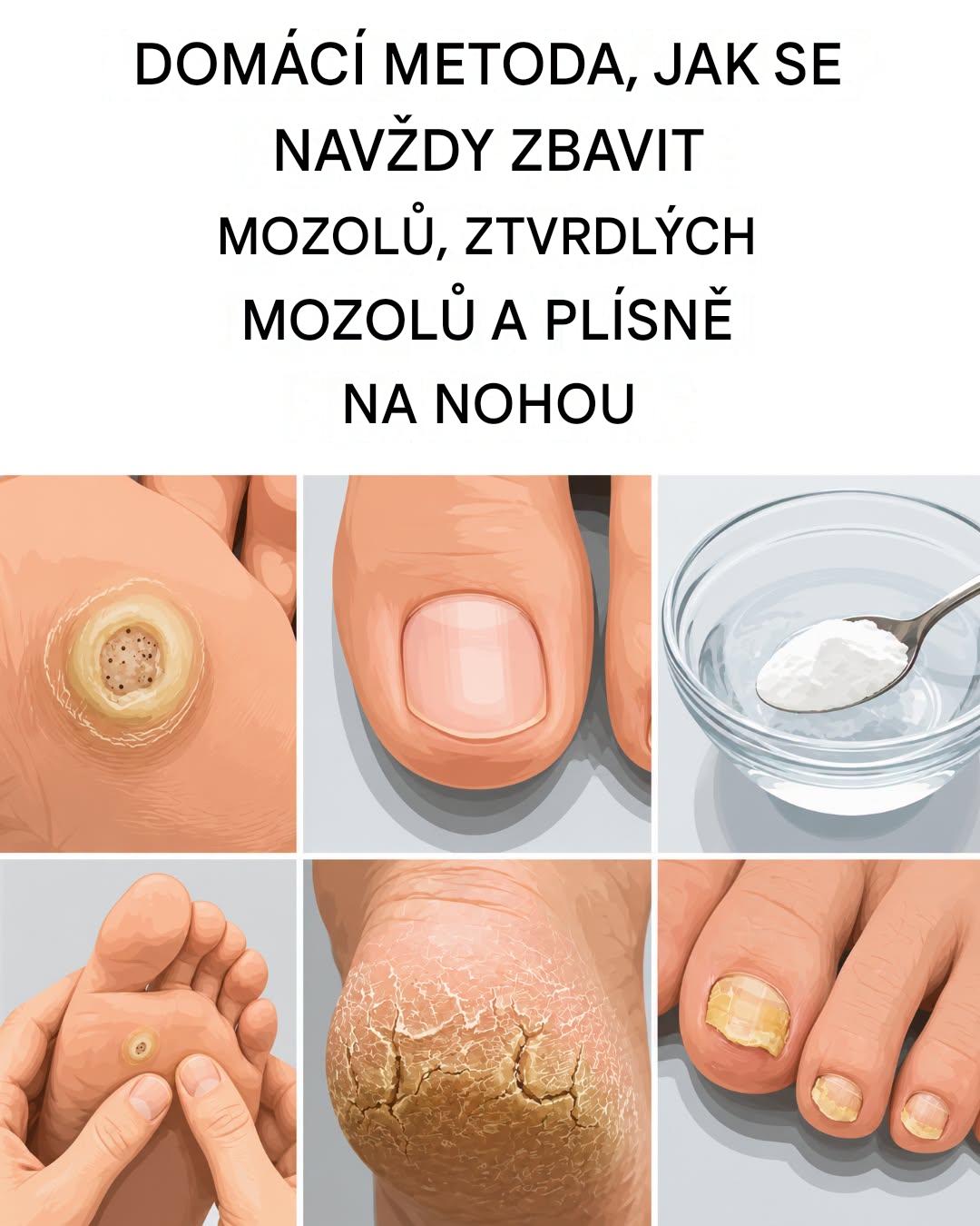 Jak se rychle a trvale zbavit kuřích ok, mozolů a plísní na nohou