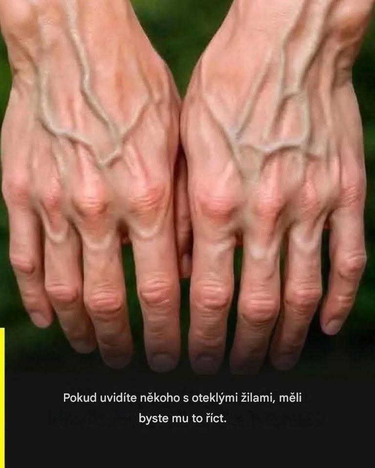 Pokud máte viditelné žíly, znamená to, že… Číst dál