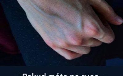 Co mohou žíly na vašich rukou prozradit o zdraví vašich jater