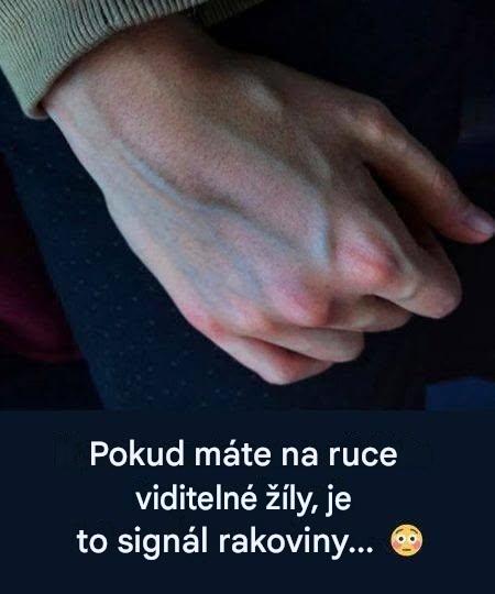 Co mohou žíly na vašich rukou prozradit o zdraví vašich jater